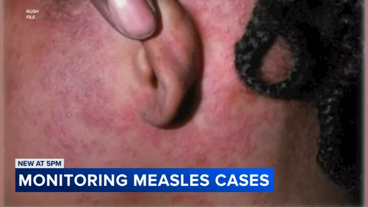 Top state, city health officials discuss lessons learned from Chicago measles outbreak