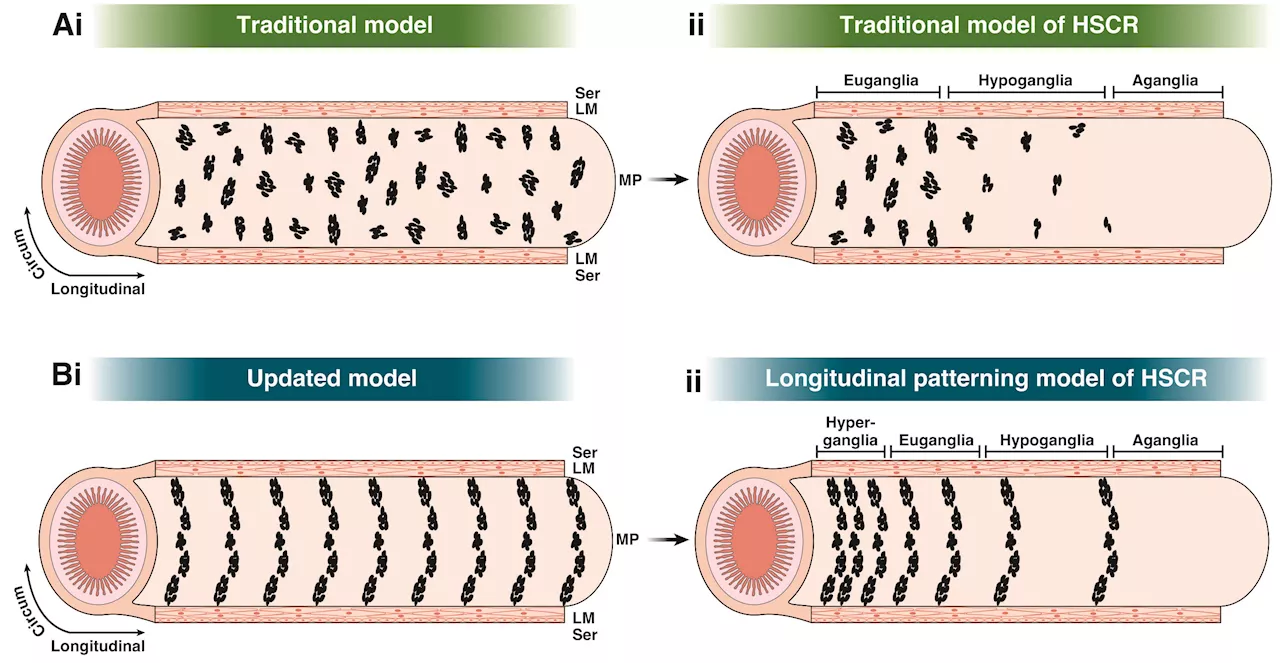 Intestinal neurons in infancy could explain wide-ranging gastrointestinal disorders in children