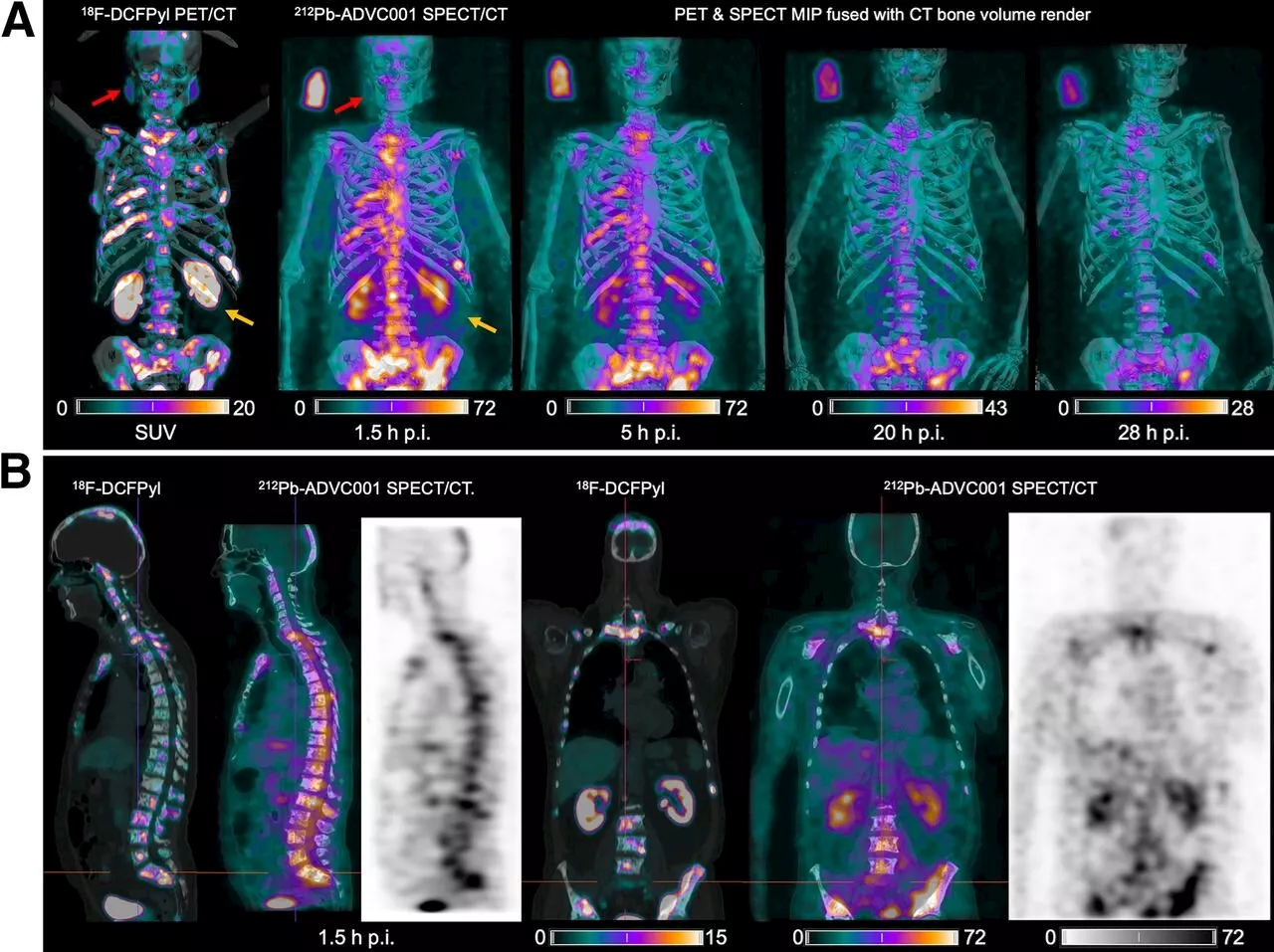 New SPECT/CT technique shows impressive biomarker identification, offers increased access for prostate cancer patients