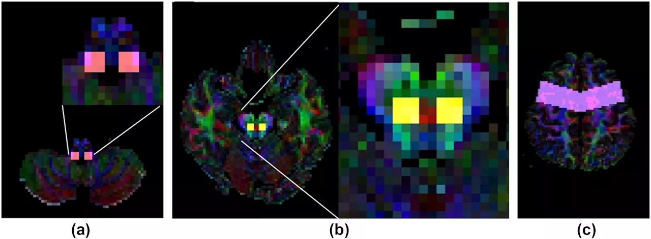 Research suggests answer to adolescent idiopathic scoliosis may reside in brain's corticoreticular pathway