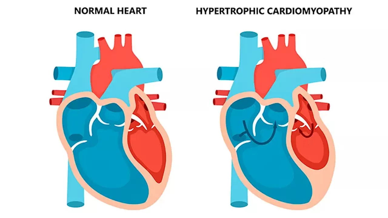 Neutral Result With Novel Agent in Diabetic Cardiomyopathy