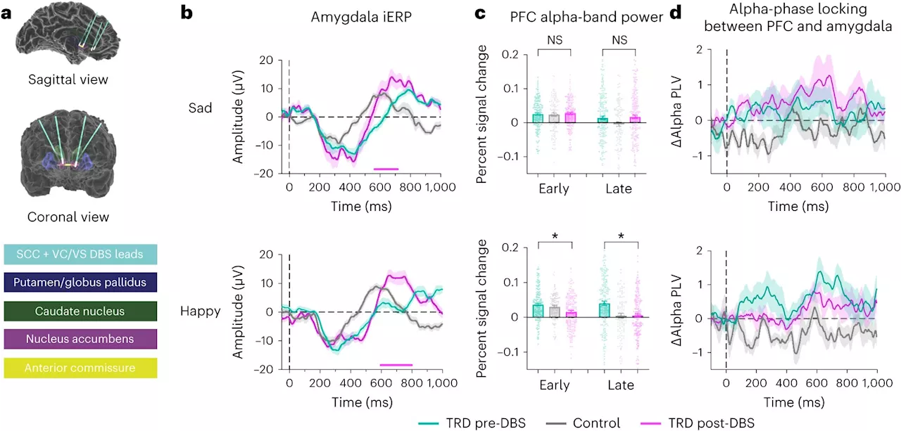 Understanding the brain mechanisms behind emotion processing bias in treatment-resistant depression