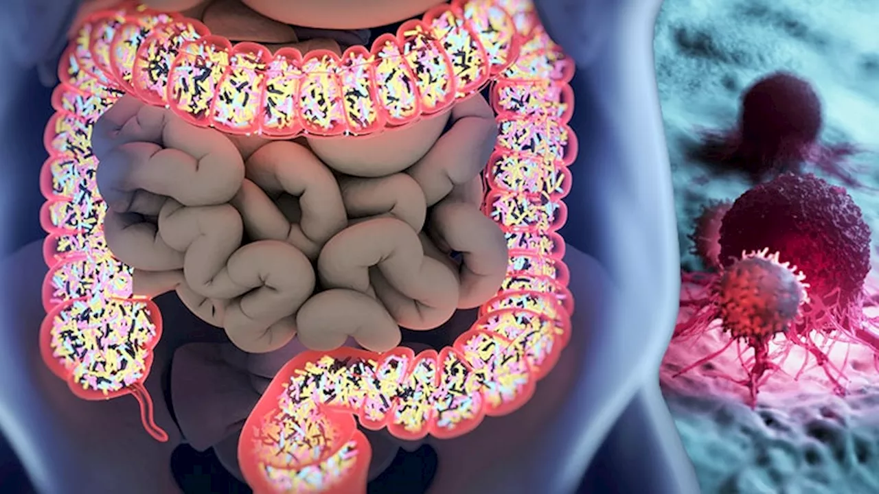 Microbial Signature of KRAS-Mutated Colorectal Cancer Identified