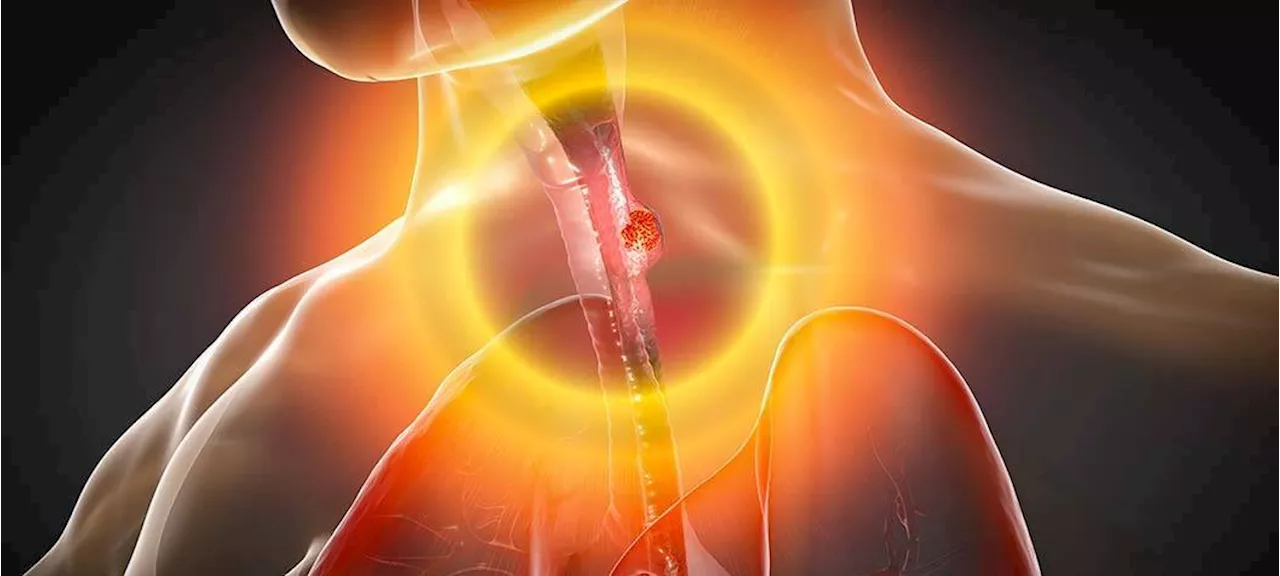 منصة للذكاء الاصطناعي تضاعف معدلات الاكتشاف المبكر لسرطان المريء