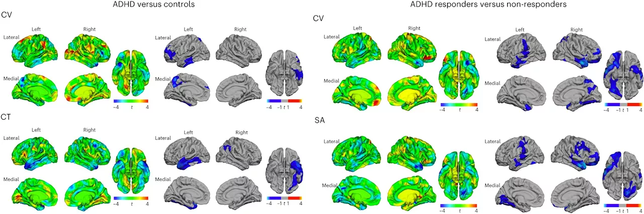 Responsiveness to ADHD treatment may be determined by neuroanatomy