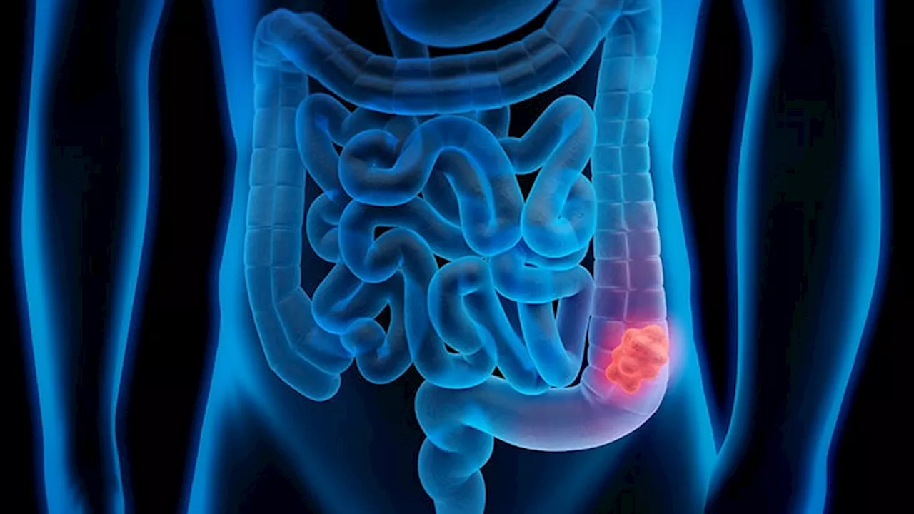 Can DNA Tests Promote Colorectal Cancer Screening?