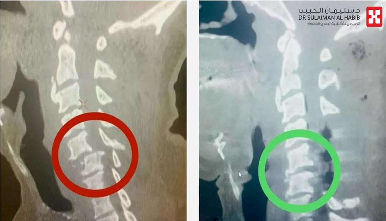 مستشفى الدكتور سليمان الحبيب بالقصيم يعيد الأمل لـ'ستيني' أصيب بالشلل الرباعي بعد حادث مروري مروع