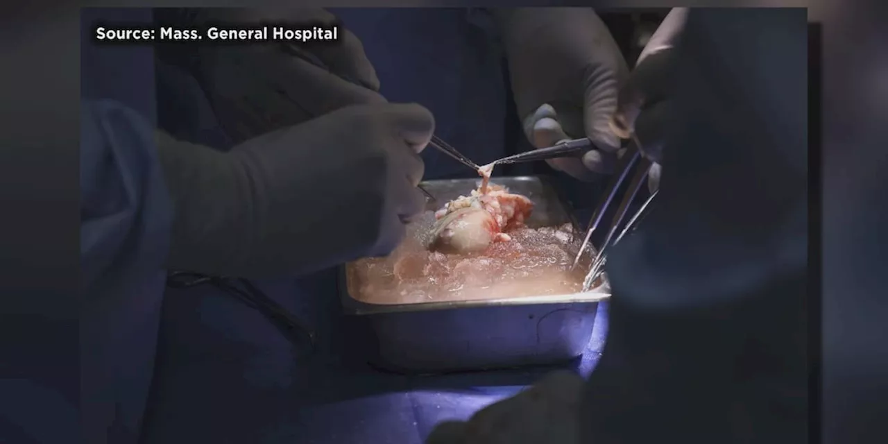 ‘I think we should absolutely be excited’: UAB surgeon hopeful after first successful pig kidney transplant in live patient