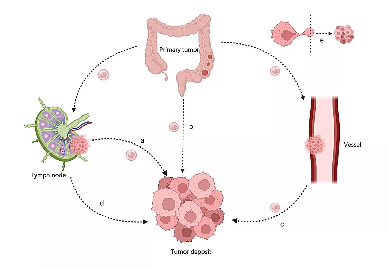Tumor deposits in colorectal and gastric cancers