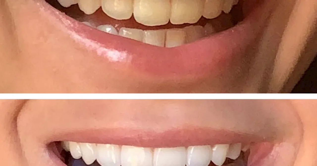 Coffee drinkers insist £17 teeth whitener gives 'better results' than dentists