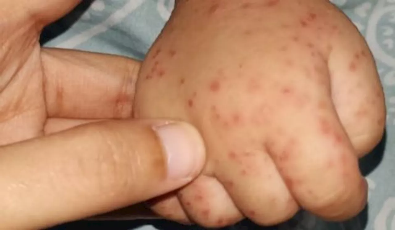 Waspada Komplikasi Flu Singapura Bisa Sebabkan Radang Otak hingga Meningitis