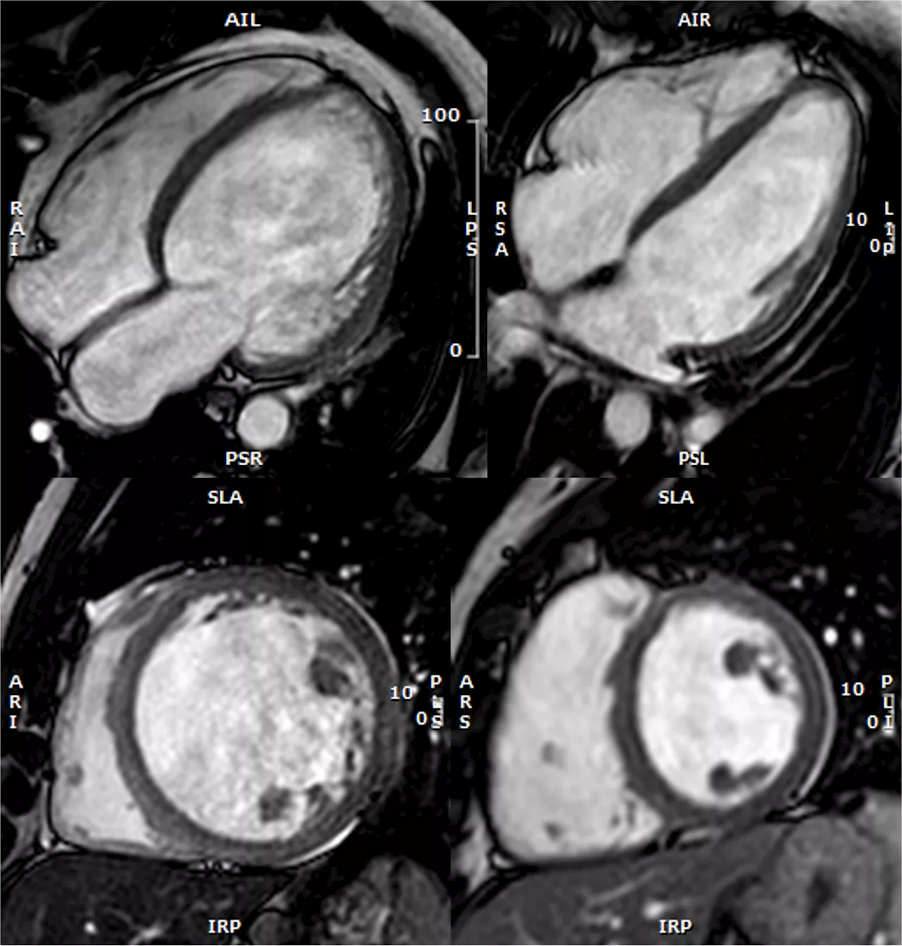 Study provides first stratification of the risk of developing dilated cardiomyopathy in symptom-free genetic carriers