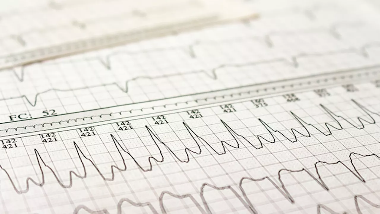 Heart Failure, Not Stroke, Most Common Complication of A-Fib