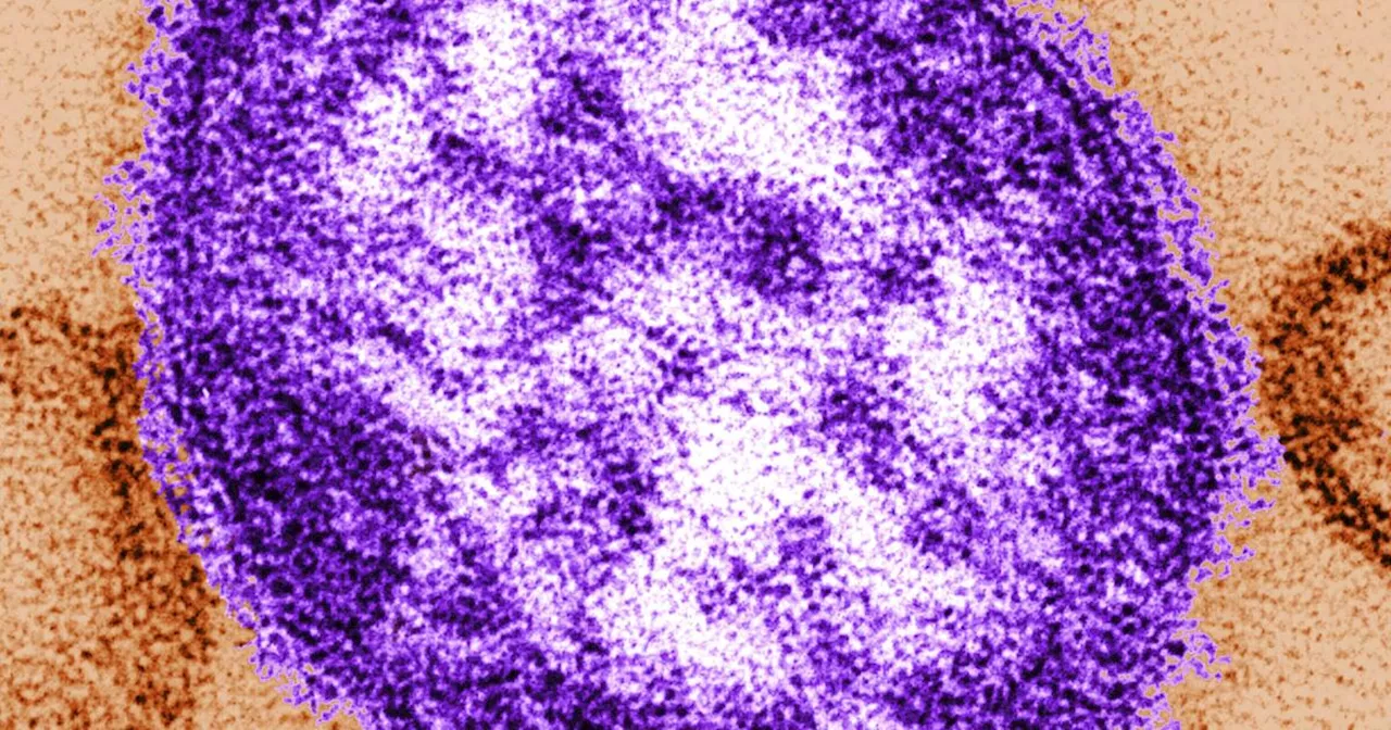 West Virginia confirms first measles case since 2009