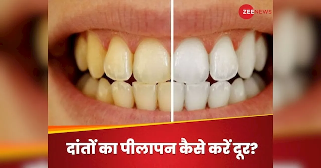 Teeth Whitening: दांतों का पीलापन करना है दूर, काम आ सकता है ये होममेड पाउडर