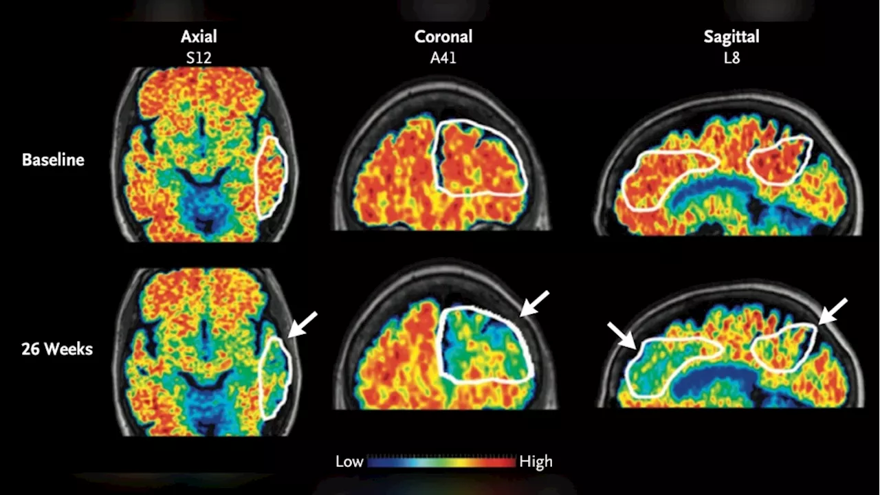 Alzheimer's drug adoption in U.S. slowed by doctors' skepticism