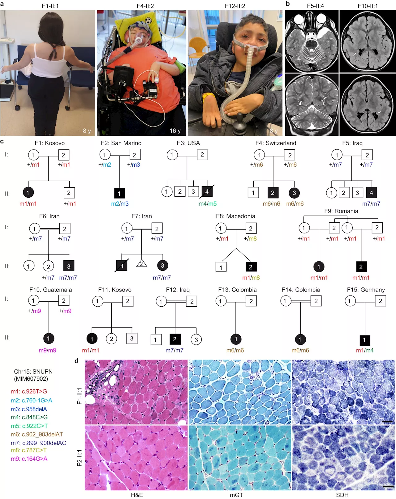 Researchers uncover SNUPN gene responsible for a new muscular disorder