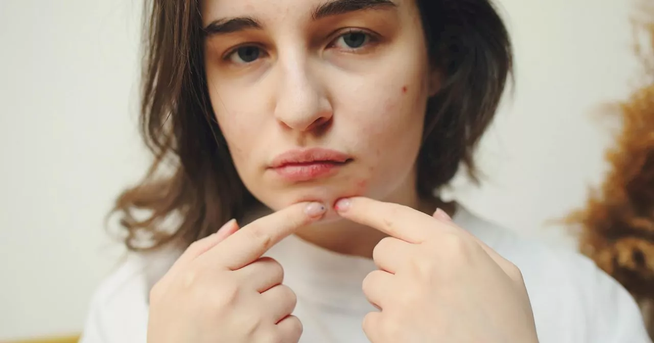 The five different types of acne, how to treat them, and helping your teen navigate breakouts