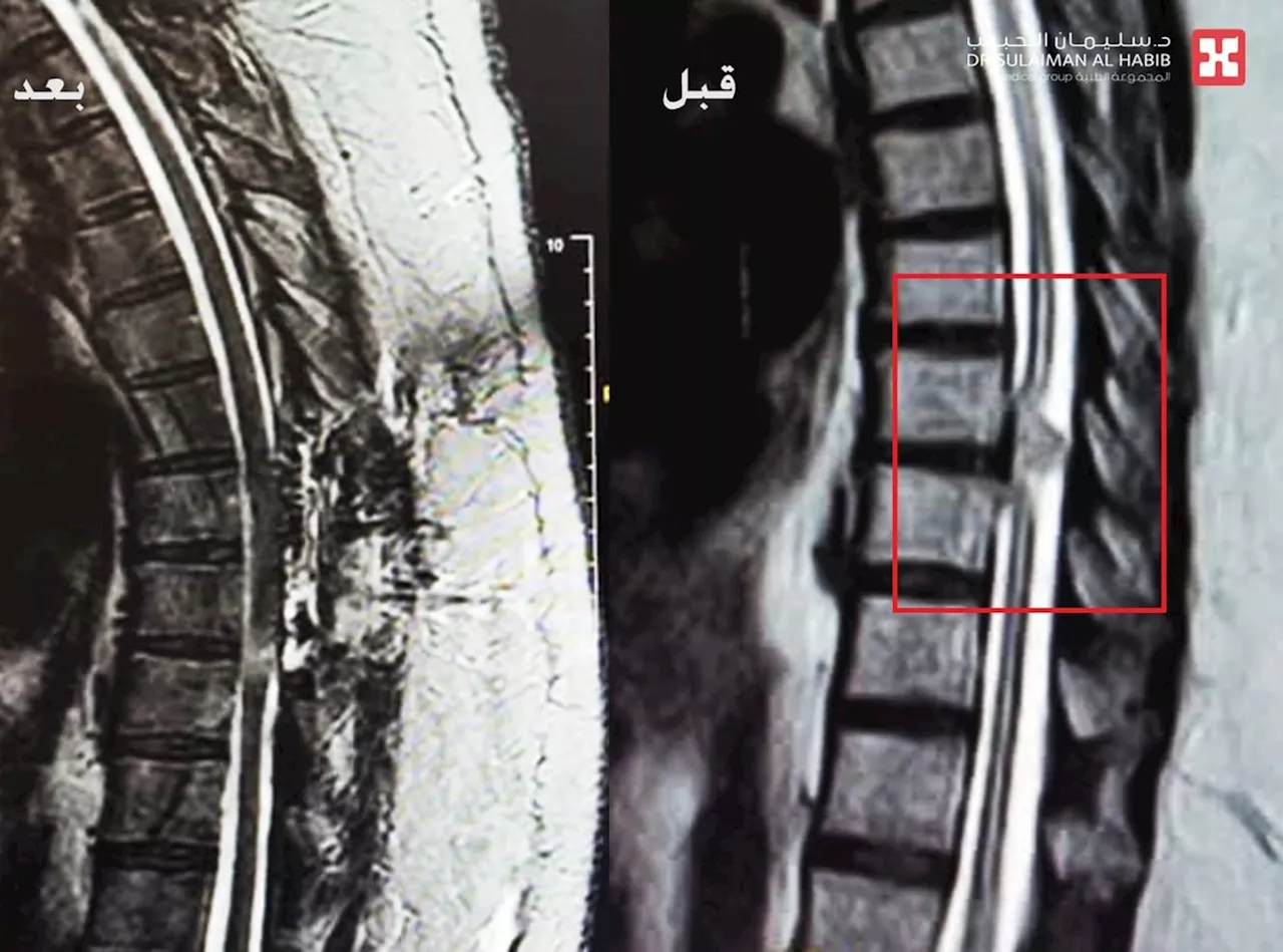 مستشفى الدكتور سليمان الحبيب بالقصيم يستأصل ورماً ضاغطاً على الحبل الشوكي أقعد أربعينية عن الحركة