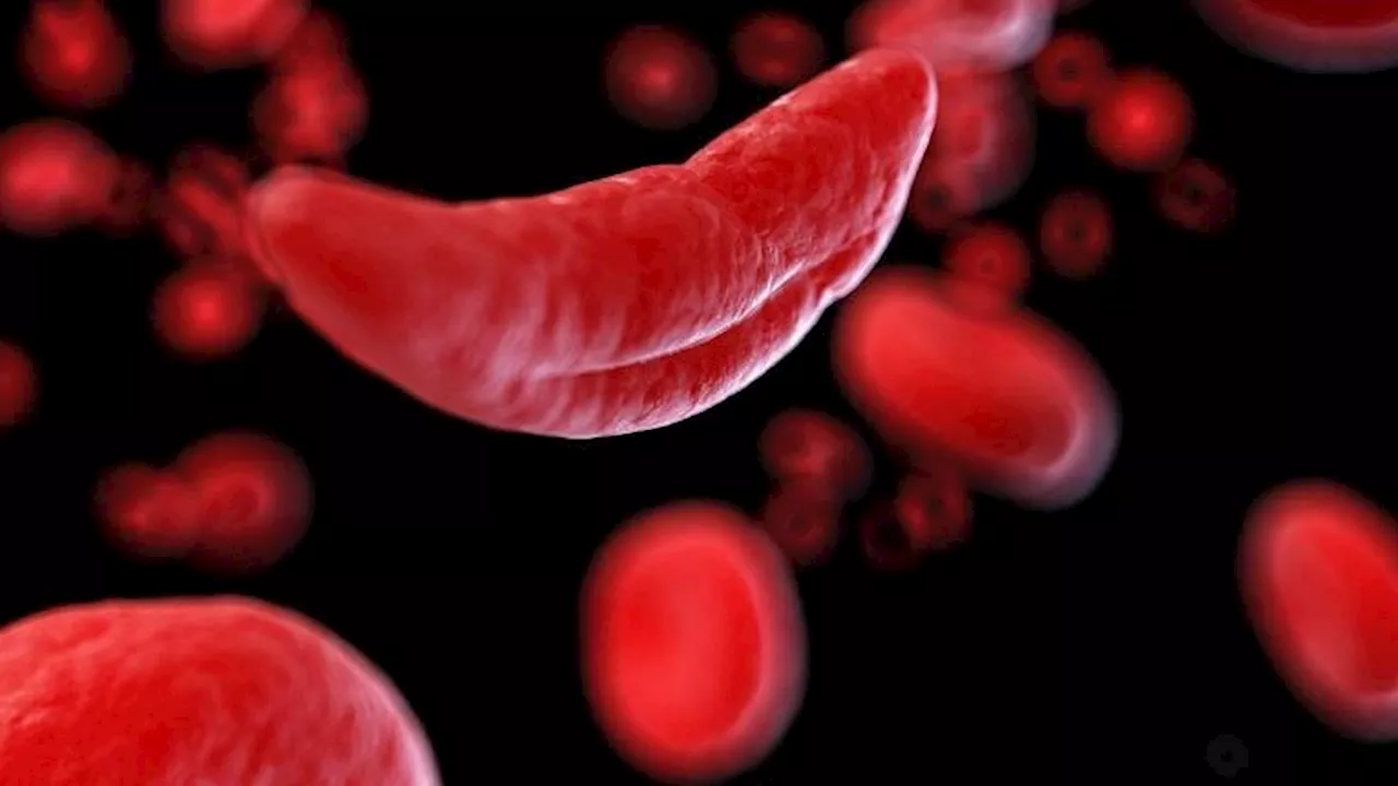 Researchers publish final results of key clinical trial for gene therapy for sickle cell disease