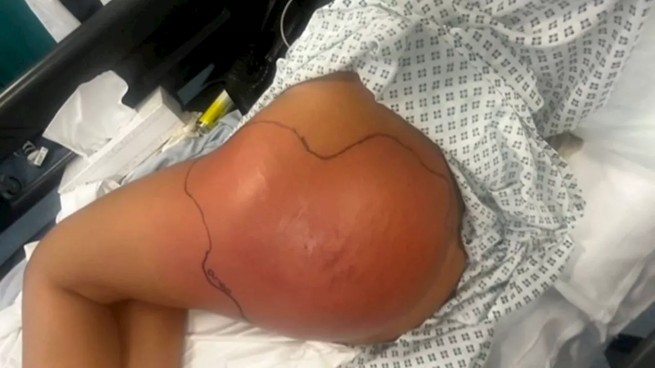 Brazilian Butt Lift: Council issues urgent warning over non-surgical procedures