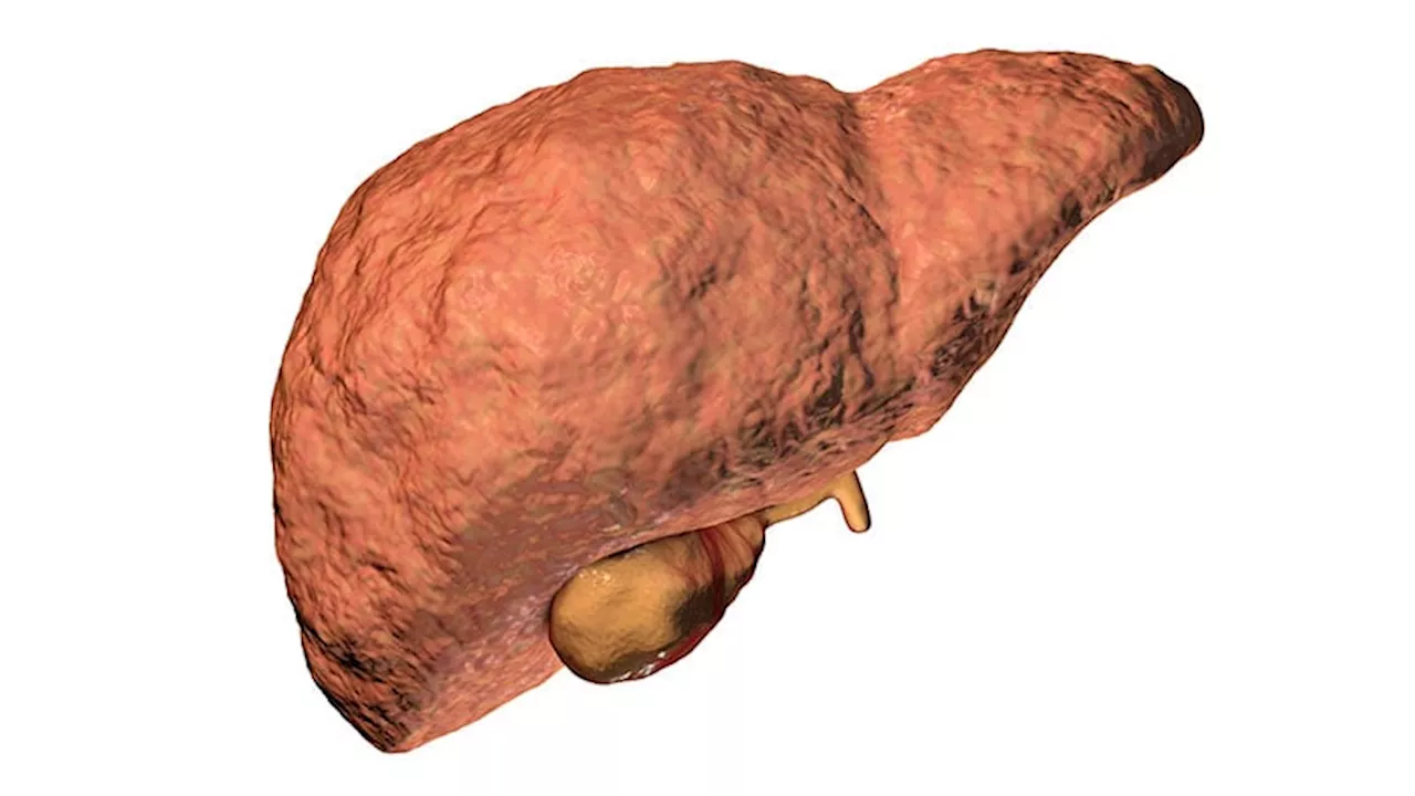 Metabolic Dysfunction-Associated Steatotic Liver Disease Plus HIV Ups Risk for CVD but Not Liver Disease