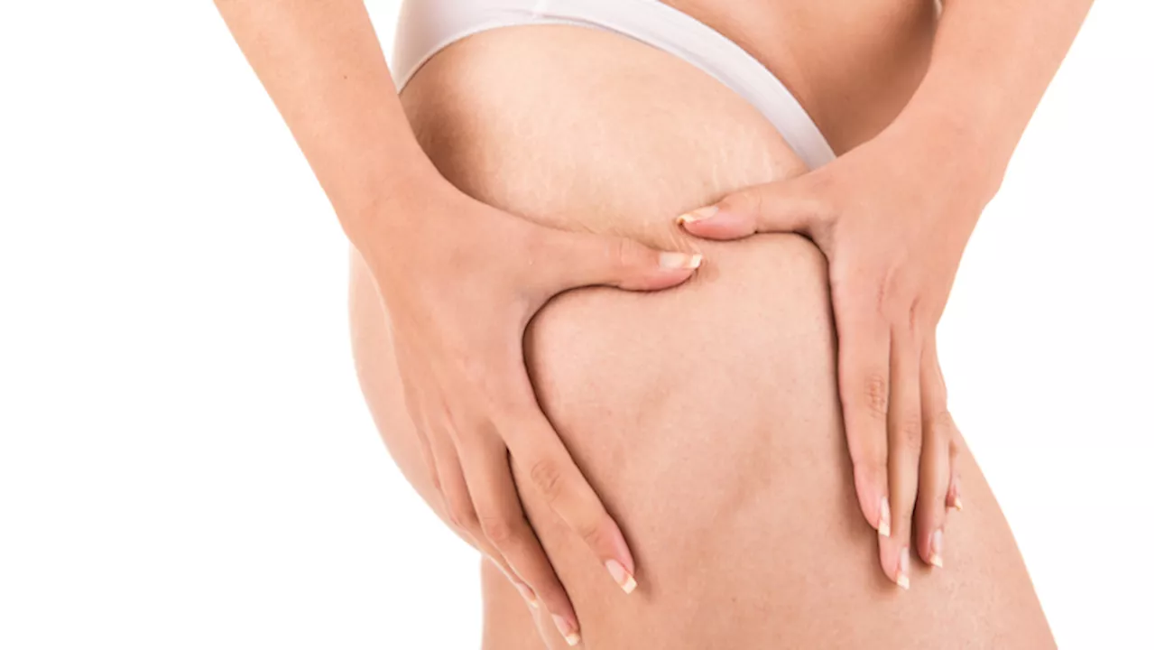 Cellulite: la puoi combattere anche a casa