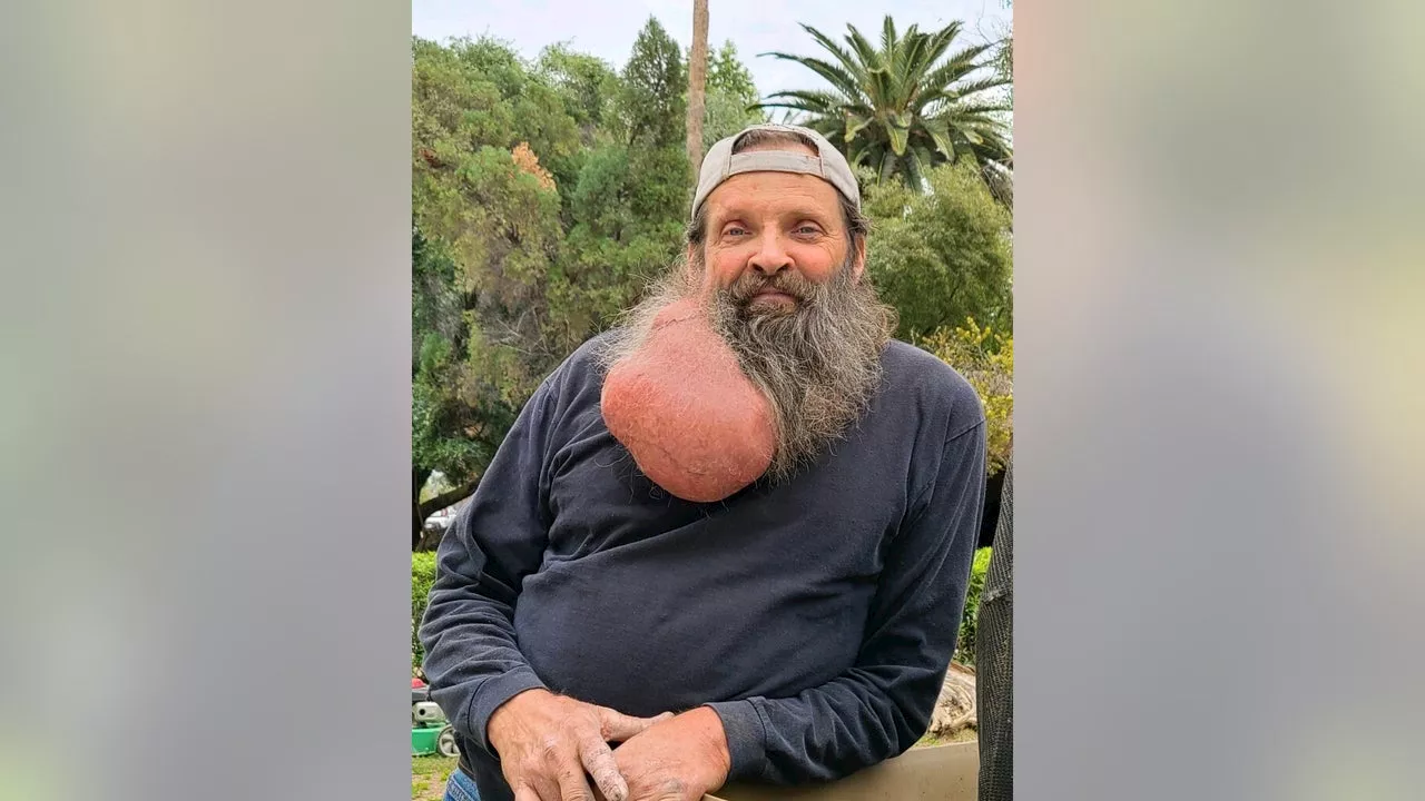 Giant tumor growing for decades removed from neck area of Scottsdale man