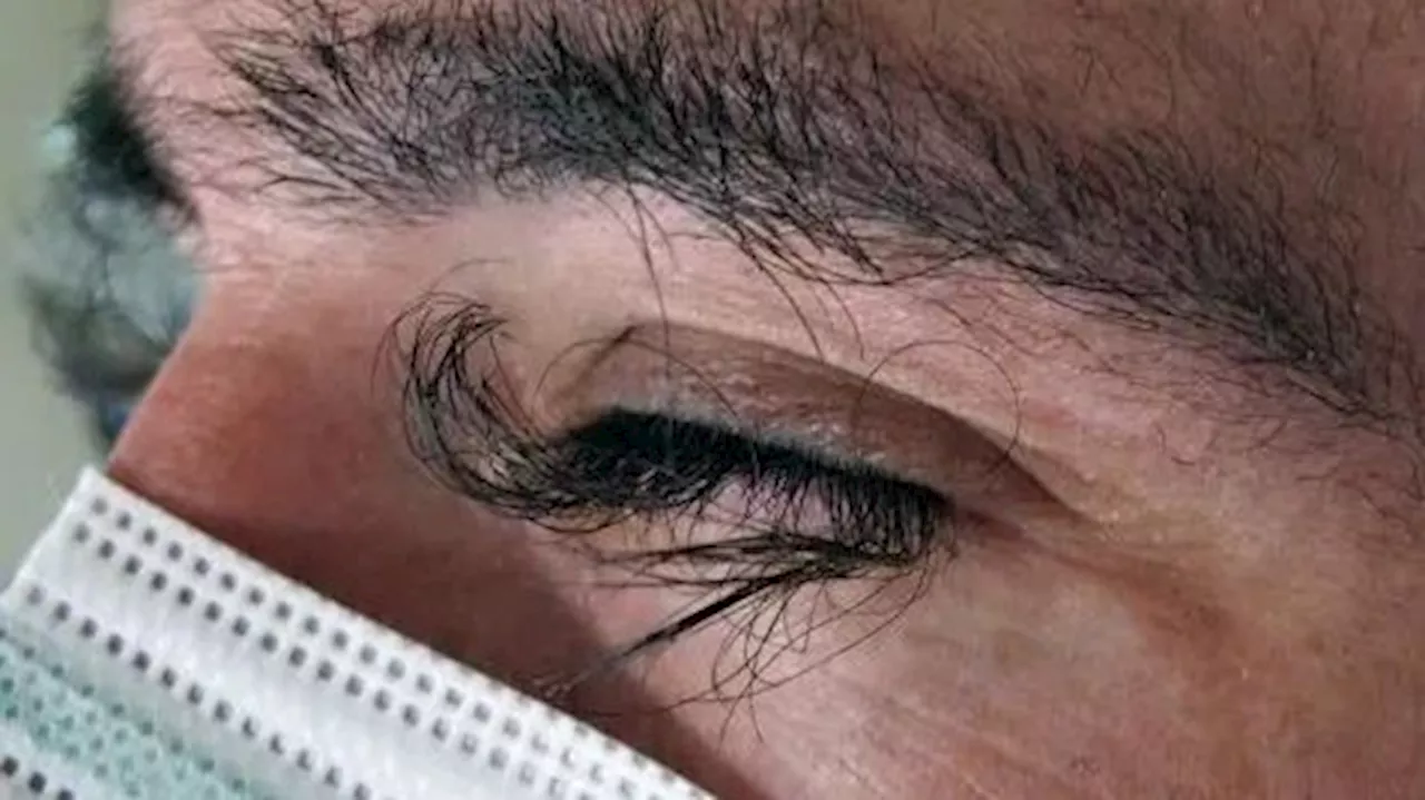 Solche Wimpern bekommt Mann nach Chemotherapie