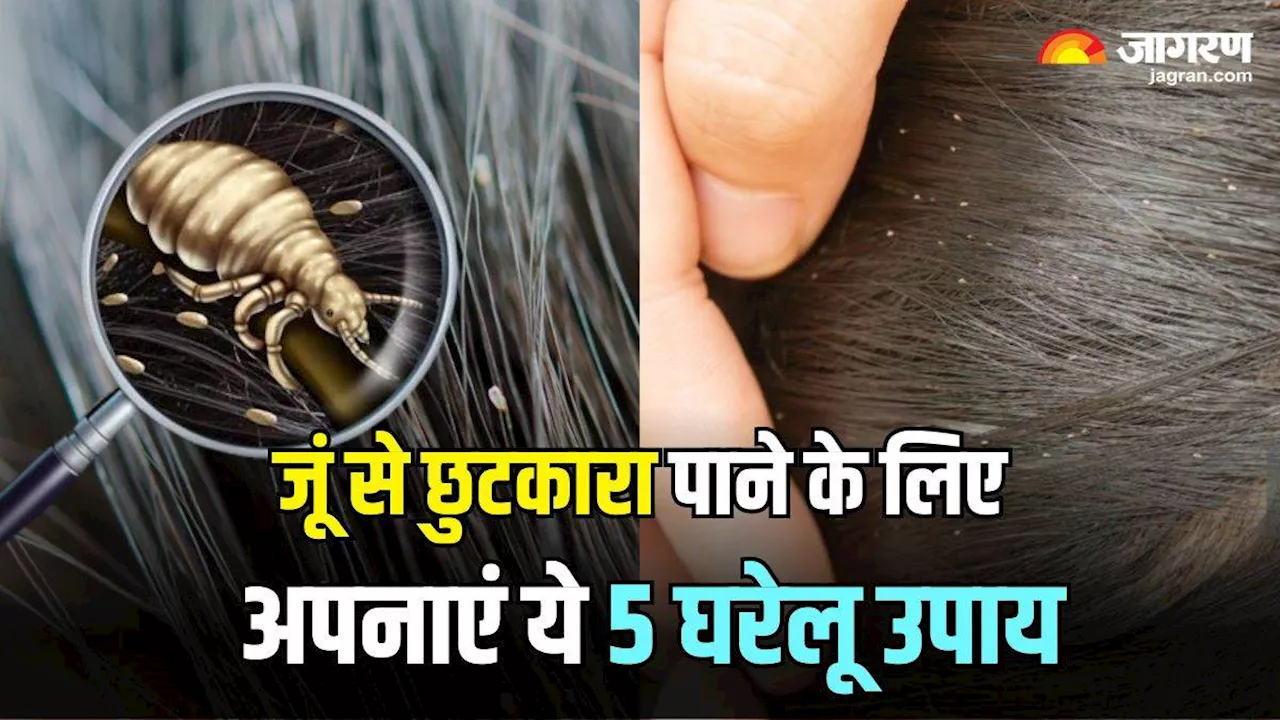 Home Remedies For Lice: सिर में हो गई है जूं और लीख, तो इन्हें जड़ से खत्म करने के लिए अपनाएं ये 5 घरेलू उपाय