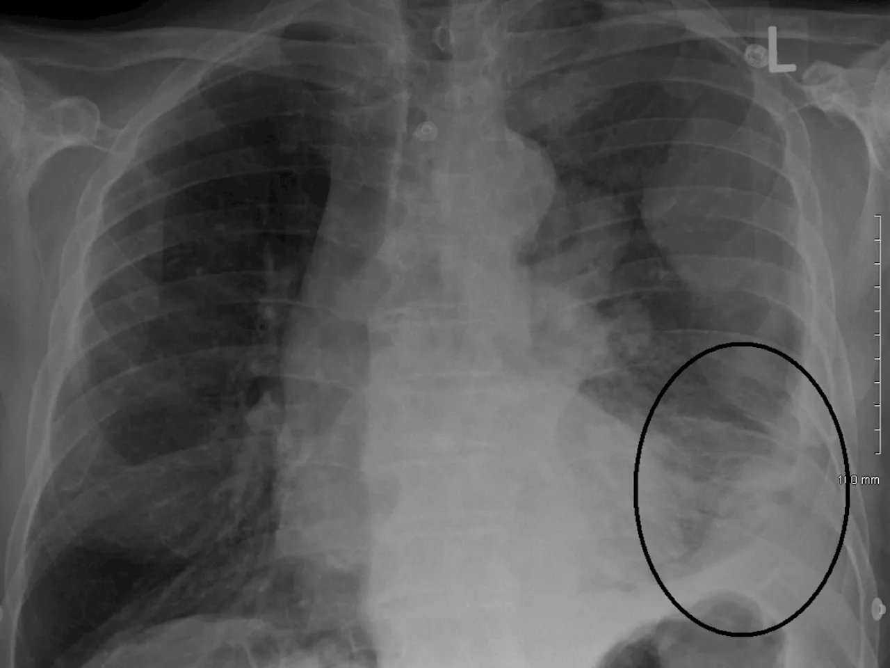 Cos'è il mesotelioma: sintomi, cause e terapie