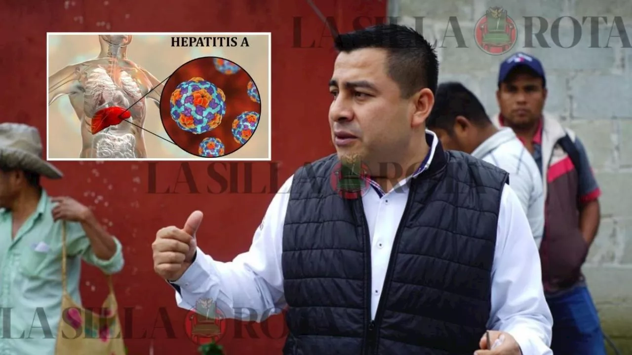 Alcalde de Zozocolco confirma 16 casos de hepatitis A, ¿qué es y cómo se transmite?