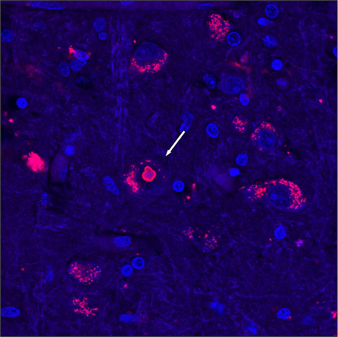 After 25 years, researchers uncover genetic cause of rare neurological disease