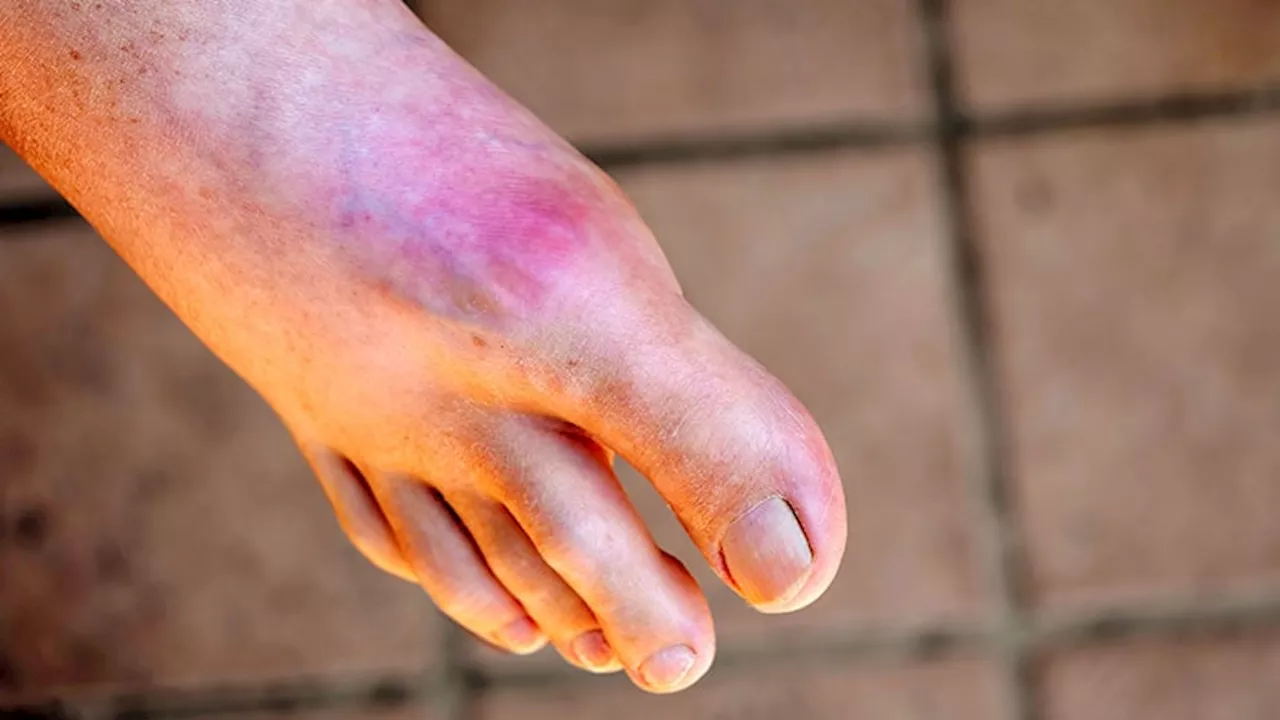 Optimized Hospital Care for Gout Improves Uptake of Urate-Lowering Therapy