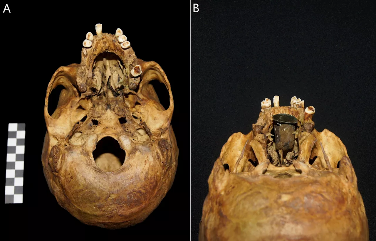 Archaeologists Discover 'Unique' Artificial Body Part in 18th Century Skull