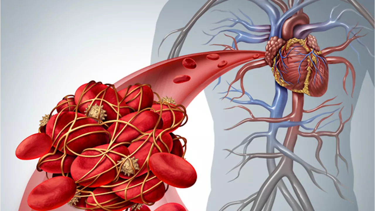 Embolia polmonare: quali sono i sintomi?