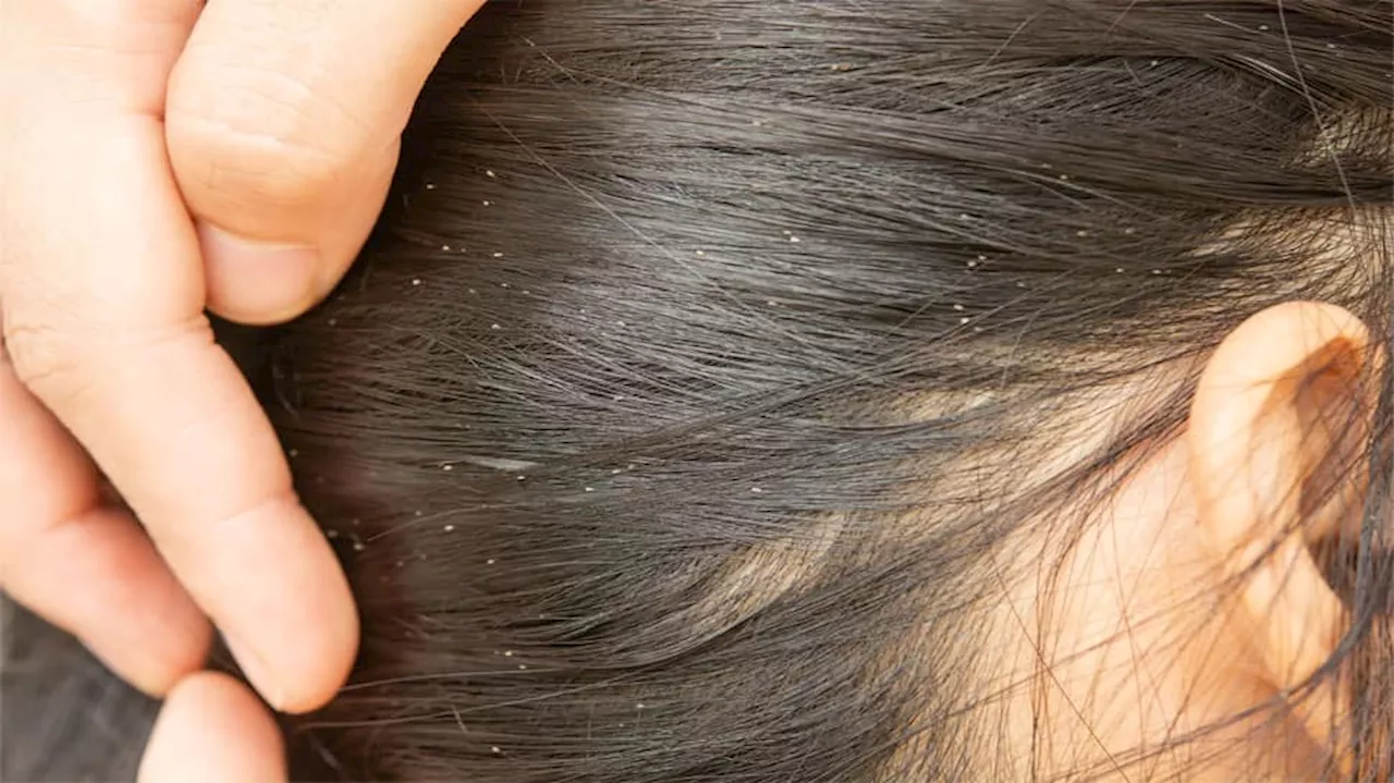 Lice Home Remedies: જૂ અને લીખથી તુરંત છુટકારો મેળવવા અપનાવો આ 5 ઘરેલુ ઉપાય