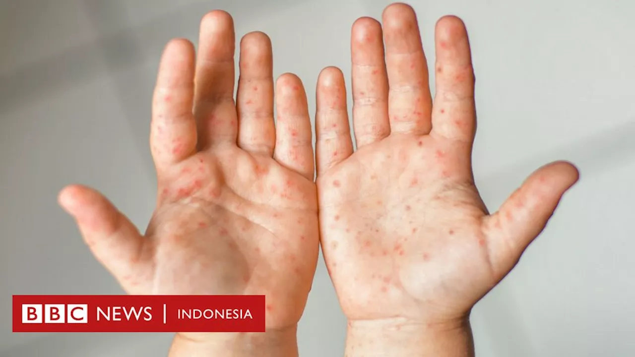 Flu Singapura berpotensi meluas saat mudik Lebaran - Bagaimana ciri-ciri, gejala, dan cara penularannya?