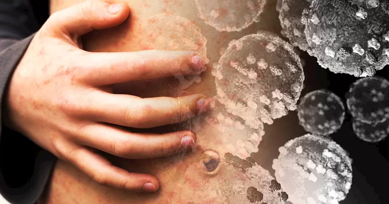 Two new cases of measles confirmed in State