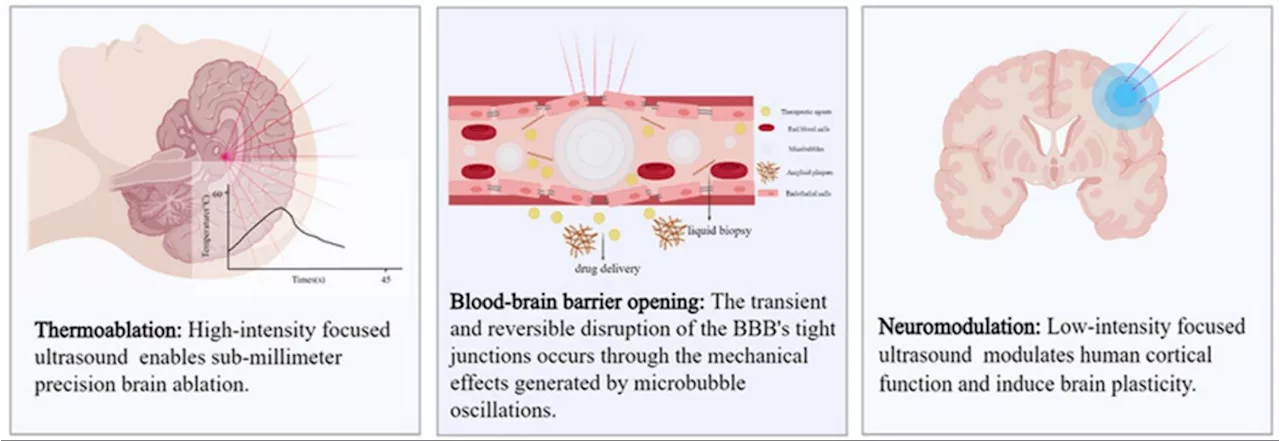 Magnetic Resonance-Guided Focused Ultrasound in Intracranial Diseases