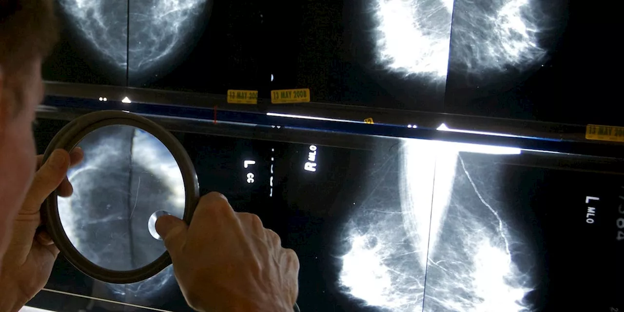 Mammograms should start at 40 to address rising breast cancer rates at younger ages, panel says