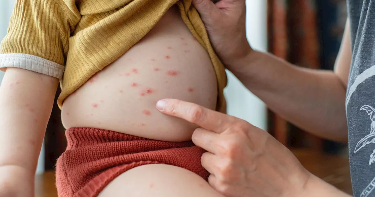 1 Thing You Should NEVER Do If Your Child Has Chickenpox