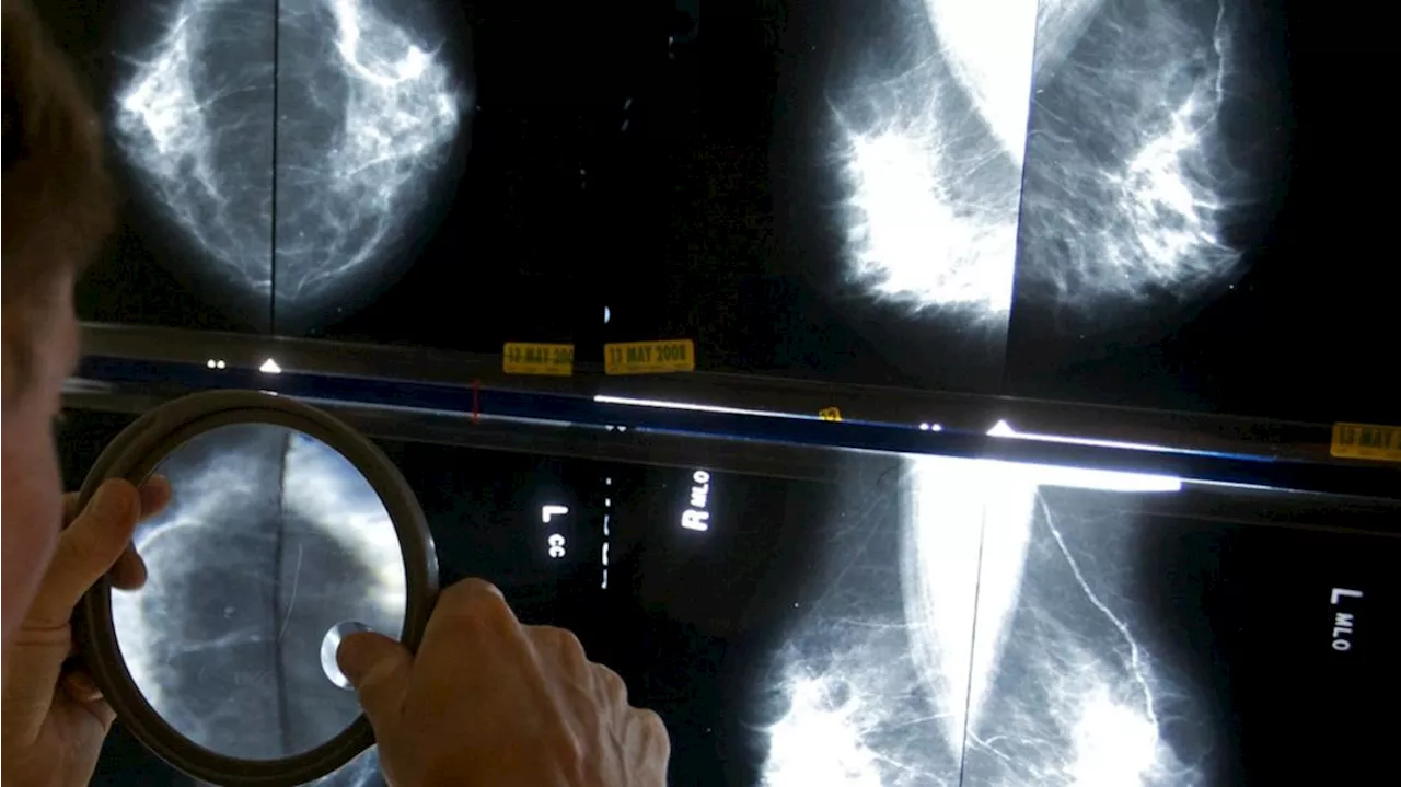 Mammograms should start at 40 to address rising breast cancer rates at younger ages, panel says