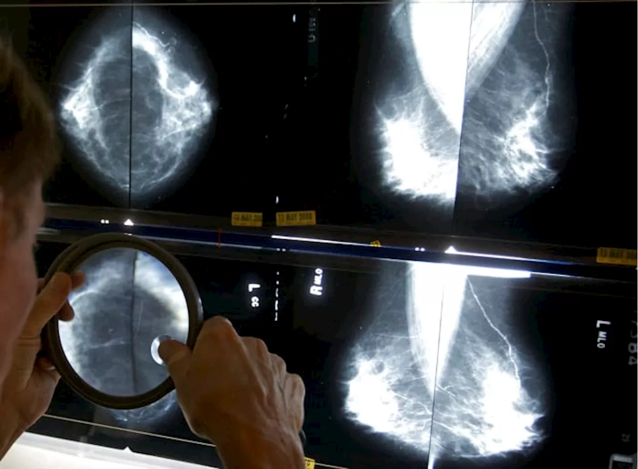 Mammograms should start at 40 to address rising breast cancer rates at younger ages, panel says