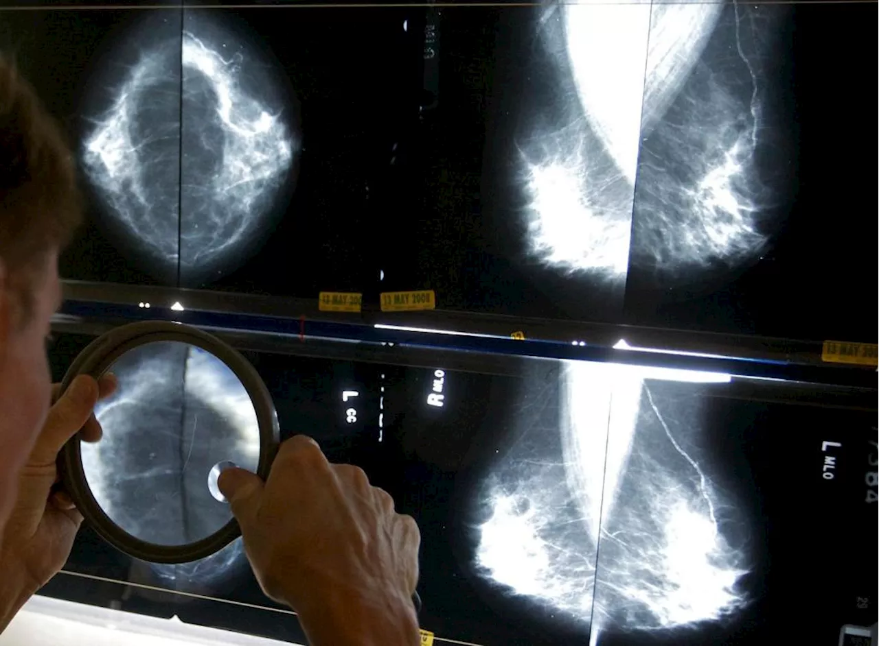 Mammograms should start at 40, panel says, as breast cancer rates rise in younger women