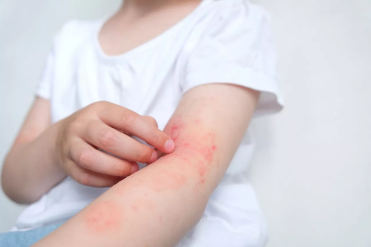 Study investigates the potential effects of neonatal vitamin D on eczema up to adulthood