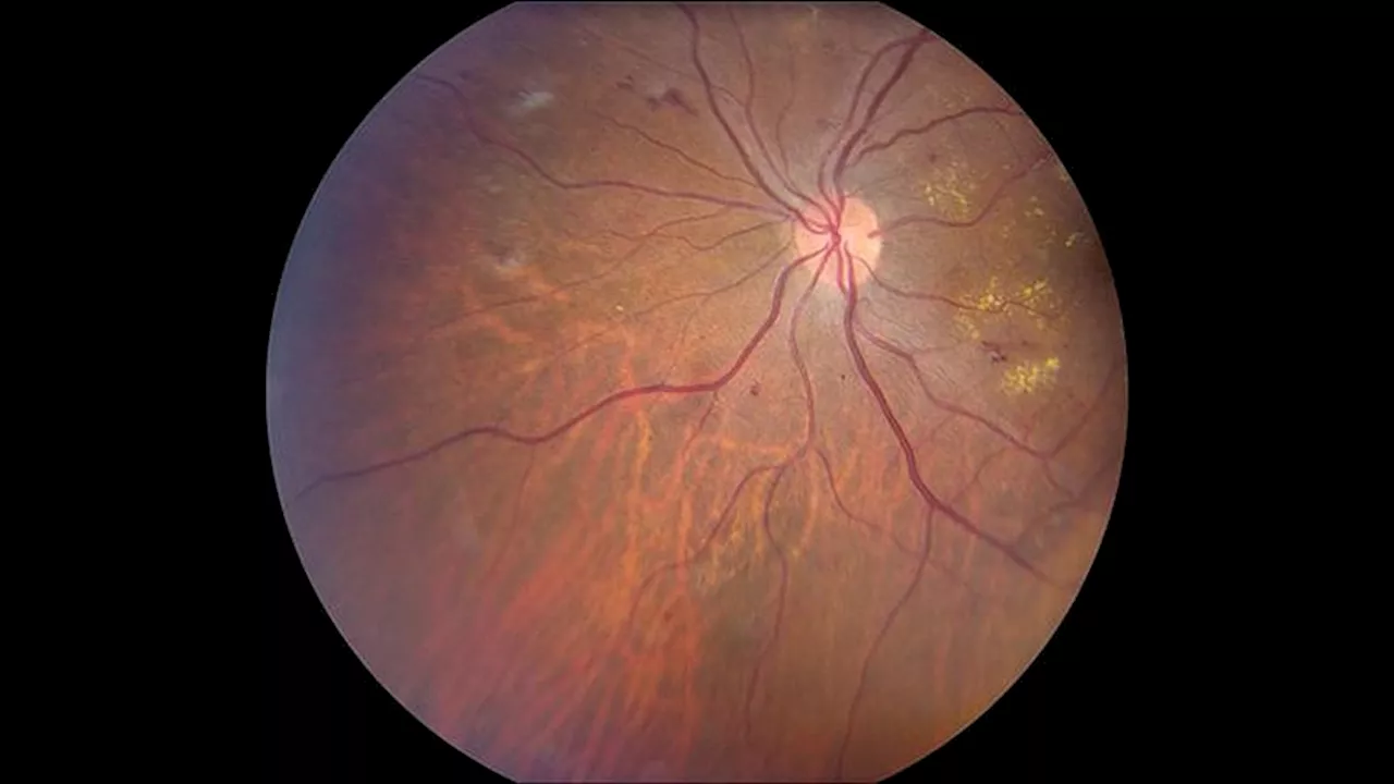 CGM Associated With Lower Retinopathy Risk in T1D