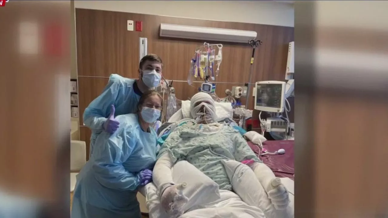 Houston man survives after 90% of his body was burned