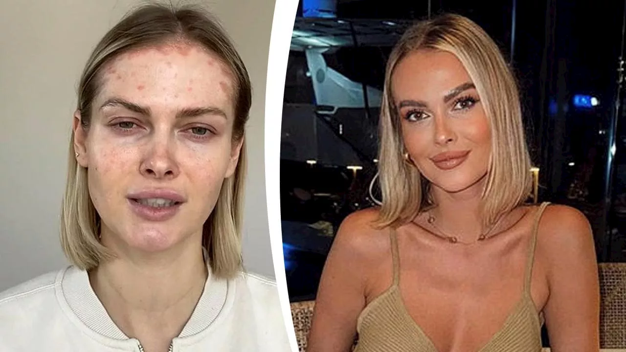 „GNTM“-Model Darya Strelnikova: So leide ich unter meiner Schuppenflechte