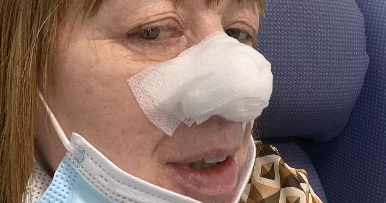 Mum has chunk of nose cut off after dentist recognizes 'spot' as cancer